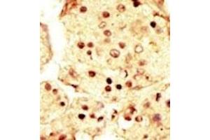 Formalin-fixed and paraffin-embedded human cancer tissue reacted with the primary antibody, which was peroxidase-conjugated to the secondary antibody, followed by AEC staining. (MAP3K9 antibody  (N-Term))