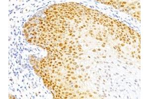 Formalin-fixed, paraffin-embedded human cervical cancer stained with p27 antibody (DCS-72. (P27 antibody)