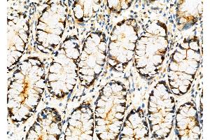 ABIN6261590 and ABIN6276833 at 1/100 staining Human colorectal cancer by IHC-P. (ERCC3 antibody  (N-Term))
