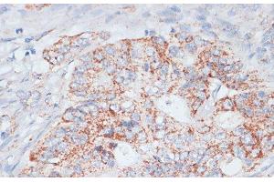 Immunohistochemistry of paraffin-embedded Human colon carcinoma using Desmoplakin Polyclonal Antibody at dilution of 1:100 (40x lens). (Desmoplakin antibody)