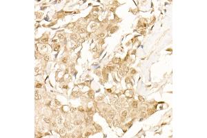 Immunohistochemistry of paraffin-embedded Human breast cancer using β-Catenin antibody (ABIN1684202, ABIN1512789, ABIN3020926 and ABIN3020928) at dilution of 25 (40x lens).