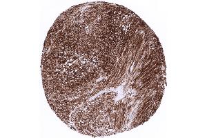 Gastrointestinal stromal tumor with strong CD34 expression (Recombinant CD34 antibody)