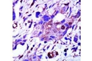 IHC analysis of FFPE human breast carcinoma tissue stained with the PLK1 antibody (PLK1 antibody  (AA 573-603))