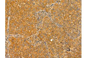ABIN6265786 and ABIN6273022 at 1/100 staining Human lung cancer by IHC-P. (TTLL6 antibody  (N-Term))