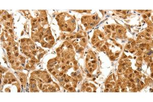 Immunohistochemistry of paraffin-embedded Human lung cancer tissue using TNN Polyclonal Antibody at dilution 1:40