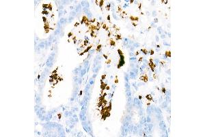 Immunohistochemistry of paraffin-embedded Human colon carcinoma using Myeloperoxidase (MPO) antibody (ABIN7268726) at dilution of 1:1000 (40x lens).