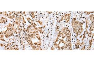 Immunohistochemistry of paraffin-embedded Human breast cancer tissue using ZNF486 Polyclonal Antibody at dilution of 1:50(x200) (ZNF486 antibody)