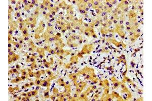 Immunohistochemistry of paraffin-embedded human liver cancer using ABIN7169191 at dilution of 1:100 (TAO Kinase 2 antibody  (AA 719-880))