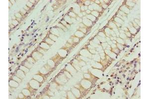 Immunohistochemistry of paraffin-embedded human colon cancer using ABIN7168228 at dilution of 1:100