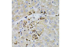 Immunohistochemistry of paraffin-embedded human liver injury using BEST1 antibody (ABIN4903043) at dilution of 1:100 (40x lens). (Bestrophin 1 antibody)
