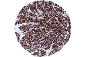 Uterus Leiomyosarcoma showing intense Caldesmon immunostaining of tumor cells Caldesmon immunohistochemistry (Recombinant Caldesmon antibody)