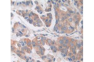 Used in DAB staining on fromalin fixed paraffin- embedded breast cancer tissue