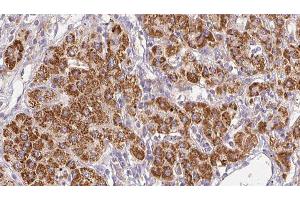 ABIN6278498 at 1/100 staining Human liver cancer tissue by IHC-P. (SLC22A6 antibody  (Internal Region))
