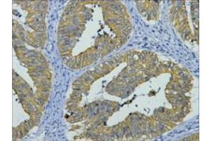 Immunohistochemistry (IHC) staining of Human Colon cancer tissue, diluted at 1:200. (KRT8 antibody)