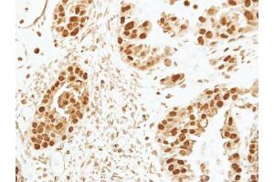 IHC-P Image Immunohistochemical analysis of paraffin-embedded human ovarian cancer, using CENPF, antibody at 1:250 dilution. (CENPF antibody  (C-Term))