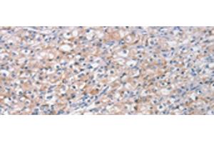 Immunohistochemistry of paraffin-embedded Human prost ate cancer tissue using STK16 Polyclonal Antibody at dilution of 1:30(x200) (STK16 antibody)
