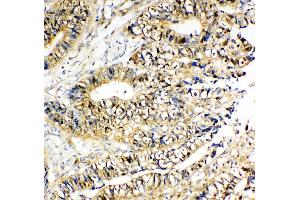 Anti-NME2 antibody, IHC(P) IHC(P): Human Intestinal Cancer Tissue (NME2 antibody  (C-Term))