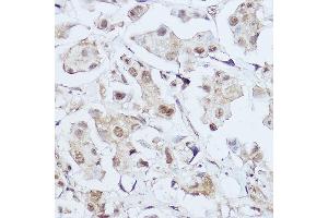 Immunohistochemistry of paraffin-embedded human breast cancer using GLI1 Rabbit pAb (ABIN7271533) at dilution of 1:150 (40x lens).