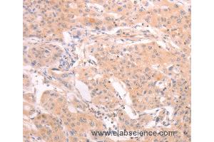 Immunohistochemistry of Human lung cancer using INA Polyclonal Antibody at dilution of 1:25 (INA antibody)