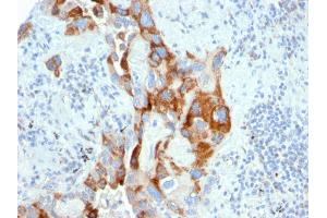 Formalin-fixed, paraffin-embedded human Colon Carcinoma stained with PMEPA1 Mouse Monoclonal Antibody (PMEPA1/2696). (PMEPA1 antibody)
