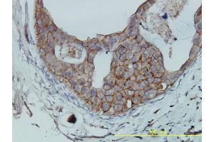 Immunoperoxidase of monoclonal antibody to F11R on formalin-fixed paraffin-embedded human breast cancer tissue. (F11R antibody  (AA 1-299))