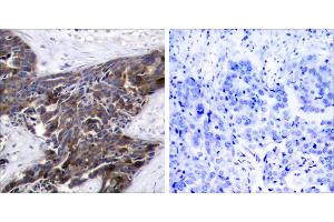 P-peptide - +Immunohistochemical analysis of paraffin-embedded human breast carcinoma tissue, using Connexin43 (Phospho-Ser367) antibody. (Connexin 43/GJA1 antibody  (pSer367))