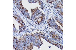 Immunohistochemistry of paraffin-embedded human colon carcinoma using Clusterin alpha chain Rabbit pAb (ABIN6133477, ABIN6138756, ABIN6138758 and ABIN6216721) at dilution of 1:100 (40x lens). (Clusterin antibody  (AA 23-120))