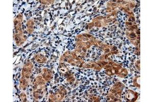 Immunohistochemical staining of paraffin-embedded Adenocarcinoma of ovary tissue using anti-LIPG mouse monoclonal antibody. (LIPG antibody)