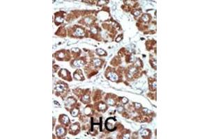 Formalin-fixed and paraffin-embedded human cancer tissue reacted with the primary antibody, which was peroxidase-conjugated to the secondary antibody, followed by DAB staining. (SIK1 antibody  (C-Term))