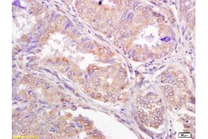 Formalin-fixed and paraffin embedded human breast carcinoma labeled with Anti-TRIM25 Polyclonal Antibody, Unconjugated (ABIN754858) at 1:200 followed by conjugation to the secondary antibody and DAB staining (TRIM25 antibody  (AA 531-630))