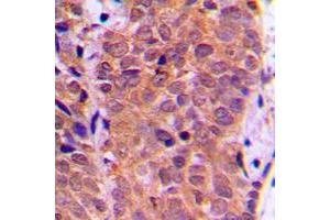 Immunohistochemical analysis of FOXO1 (pS319) staining in human breast cancer formalin fixed paraffin embedded tissue section. (FOXO1 antibody  (pSer319))