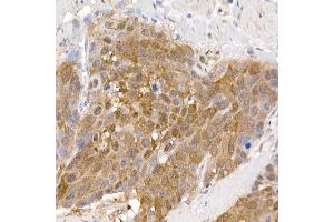 Immunohistochemistry of paraffin-embedded human esophageal cancer using PCBD1 Rabbit mAb (ABIN7269743) at dilution of 1:150 (40x lens).