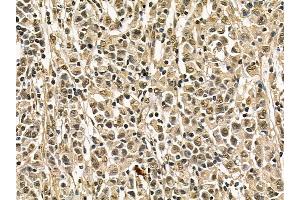 FER Mouse Monoclonal Antibody at 1/100 staining human gastric cancer by IHC-P.