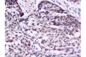 Formalin-fixed and paraffin embedded human esophagus carcinoma tissue labeled with Anti-IL-17/IL-17A Polyclonal Antibody, Unconjugated (ABIN738891) at 1:300 followed by conjugation to the secondary antibody and DAB staining (IL-17 antibody  (AA 85-150))