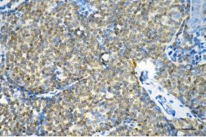 Immunohistochemistry was performed on paraffin-embedded human breast carcinoma using glutathione-disulfide reductase antibody (ABIN7798754), 1:200). (Recombinant Glutathione Reductase antibody)