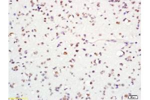 Formalin-fixed and paraffin embedded human glioma labeled with Anti-MASH1/ASCL1 Polyclonal Antibody, Unconjugated (ABIN738471) at 1:200 followed by conjugation to the secondary antibody and DAB staining