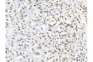 Phospho-TOPBP1 (Ser1138) Antibody at 1/100 staining Human liver cancer by IHC-P.