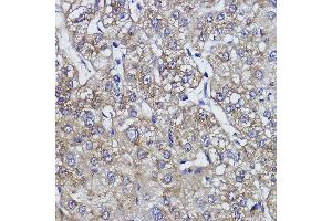 Immunohistochemistry of paraffin-embedded human liver cancer using ZNF259 Rabbit mAb (ABIN1512700, ABIN7101439, ABIN7101440 and ABIN7101441) at dilution of 1:100 (40x lens). (ZNF259 antibody)