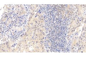 Detection of CDK4 in Human Lymphoma Tissue using Polyclonal Antibody to Cyclin Dependent Kinase 4 (CDK4) (CDK4 antibody  (AA 6-295))