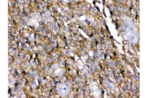 EAAT1 was detected in paraffin-embedded sections of huaman glioma tissues using rabbit anti- EAAT1 Antigen Affinity purified polyclonal antibody (Catalog # ) at 1 µg/mL. (SLC1A3 antibody  (N-Term))