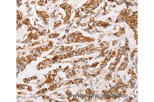 Immunohistochemistry of Human breast cancer using AK2 Polyclonal Antibody at dilution of 1:30 (Adenylate Kinase 2 antibody)