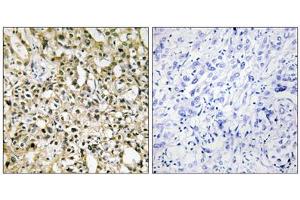 Immunohistochemistry analysis of paraffin-embedded human liver carcinoma tissue, using Myc antibody. (c-MYC antibody  (C-Term))