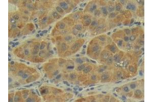 Detection of P-cadherin in Human Liver cancer Tissue using Polyclonal Antibody to Placental Cadherin (P-cadherin) (P-Cadherin antibody  (AA 371-660))