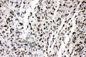 IHC analysis of ZEB1 using anti-ZEB1 antibody (ABIN7602984). (ZEB1 antibody  (Middle Region))