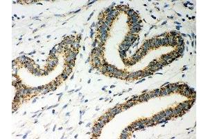 IHC-P: ERAB antibody testing of human breast cancer tissue (HSD17B10 antibody  (AA 48-261))