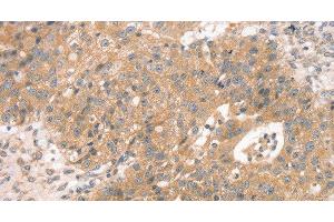 Immunohistochemistry of paraffin-embedded Human breast cancer using STX10 Polyclonal Antibody at dilution of 1:45