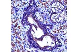 ACTG2 antibody immunohistochemistry analysis in formalin fixed and paraffin embedded human prostate cancinoma. (ACTG2 antibody  (AA 343-371))