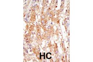 Formalin-fixed and paraffin-embedded human hepatocellular carcinoma tissue reacted with the MAP3K6 polyclonal antibody  , which was peroxidase-conjugated to the secondary antibody, followed by DAB staining. (MAP3K6 antibody  (C-Term))