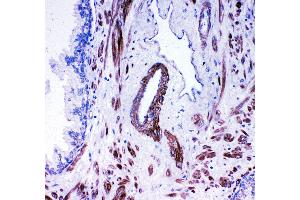 Anti- ACE antibody,  IHC(P) IHC(P): Human Prostatic Cancer Tissue (Angiotensin I Converting Enzyme 1 antibody  (Middle Region))