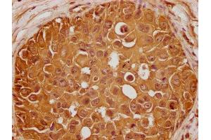 IHC image of ABIN7140243 diluted at 1:100 and staining in paraffin-embedded human breast cancer performed on a Leica BondTM system. (GLI2 antibody  (AA 2-20))
